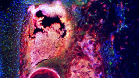 How Fat Cells in the Skin Help Fight Acne