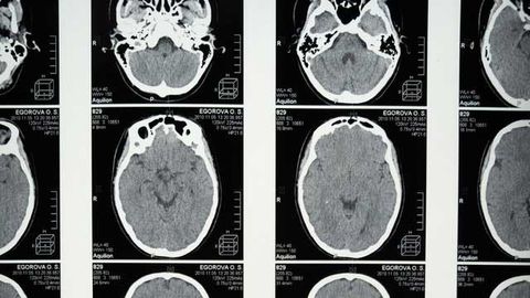 AI Study Highlights Possible Sex Differences in Autism