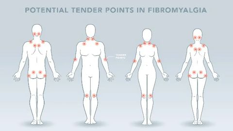 Study Examines the Brain in Juvenile Fibromyalgia for the First Time