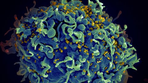 Neanderthal Gene Increases Risk of Severe COVID-19 but May Offer Protection Against HIV