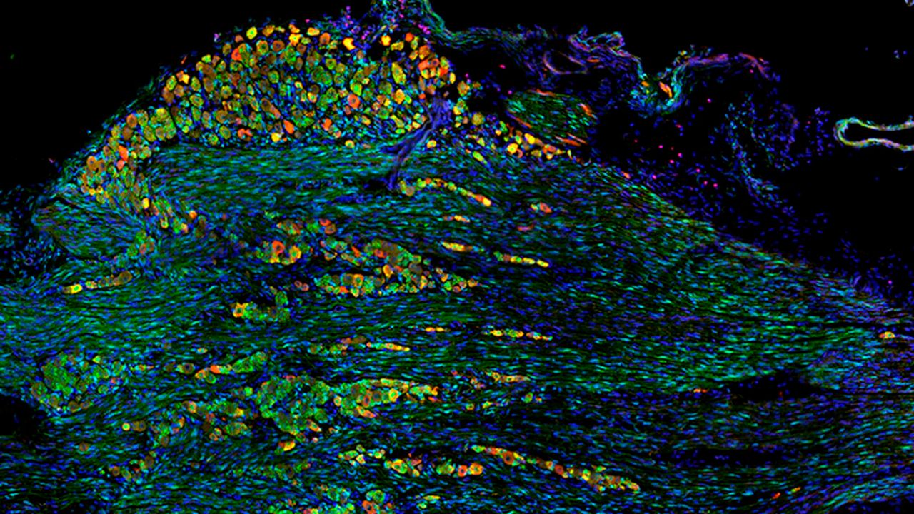 The Neural Architecture Behind Swallowing Disorders in Children
