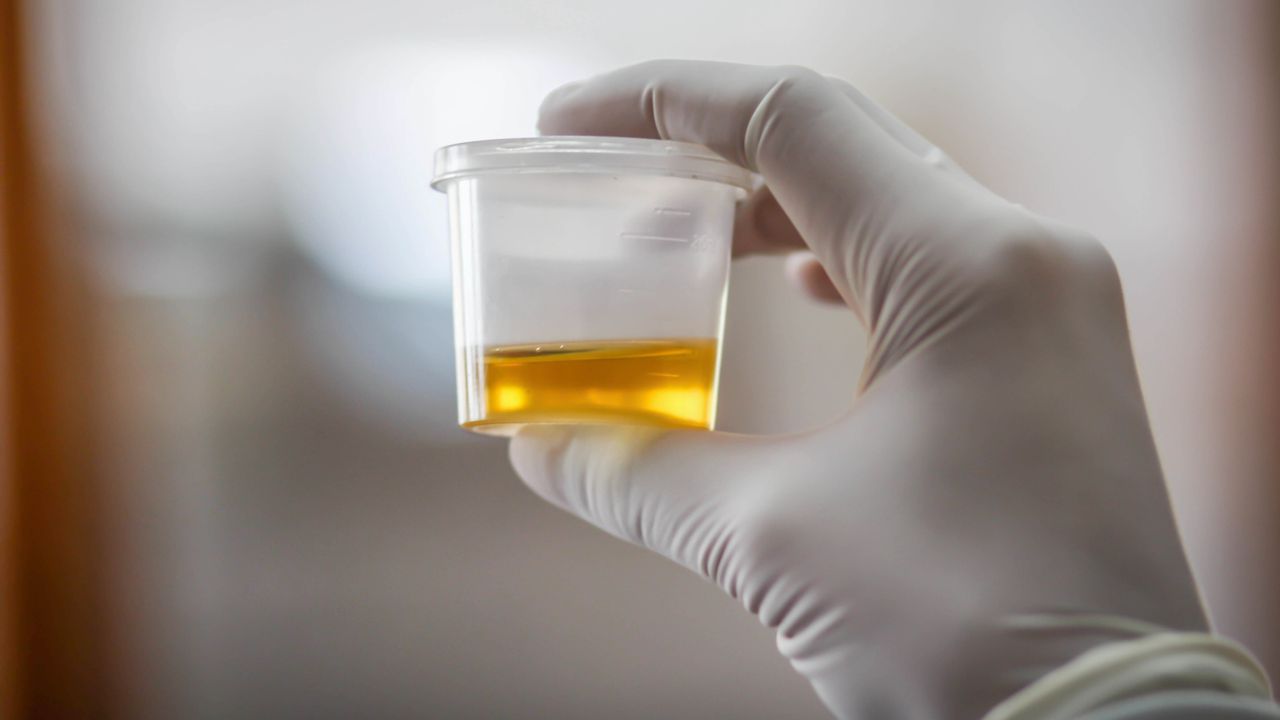Streamlining Urinalysis Workflows
