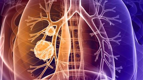 Team Halts Development of Small Cell Lung Cancer in Mice