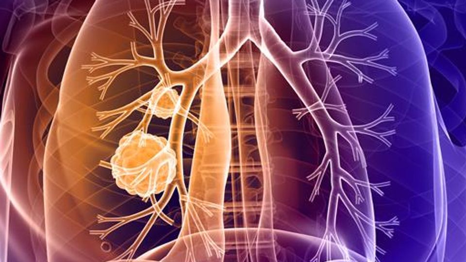 Team Halts Development of Small Cell Lung Cancer in Mice content piece image