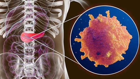 Pancreatic Cancer: Cellular Process Points To Potential Treatment Target