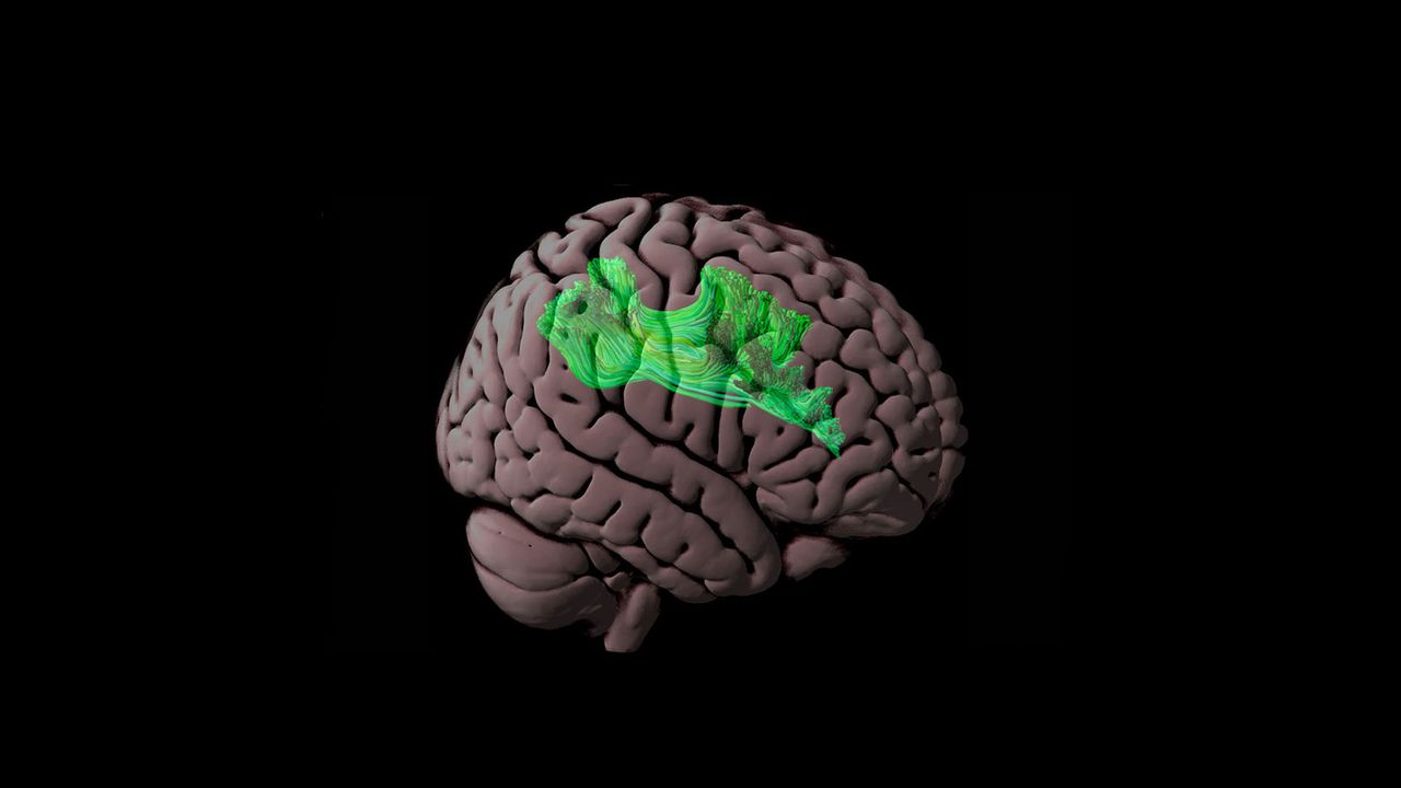 The Absent Links Between White Matter and Reading Ability