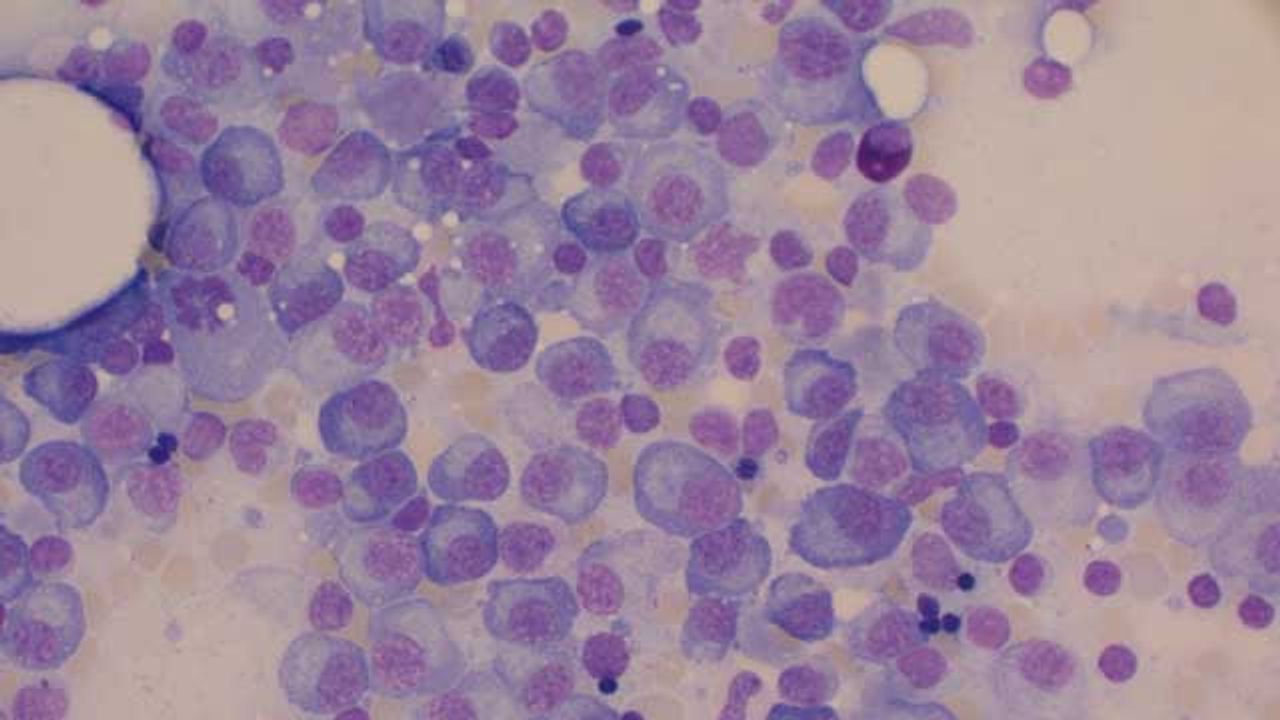 New Treatment Target for Bone Marrow Cancer