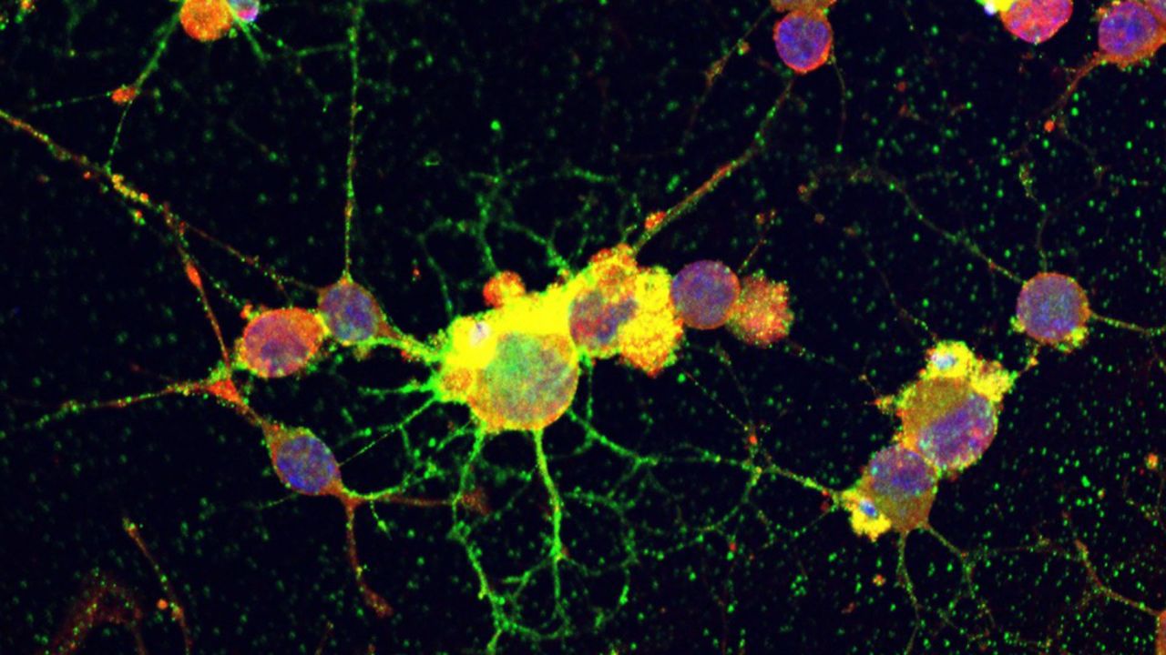 Milk Protein's Similarity to Multiple Sclerosis Target May Worsen Symptoms