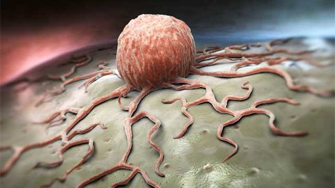 Taller Adults May Be More Likely To Develop Colorectal Cancer