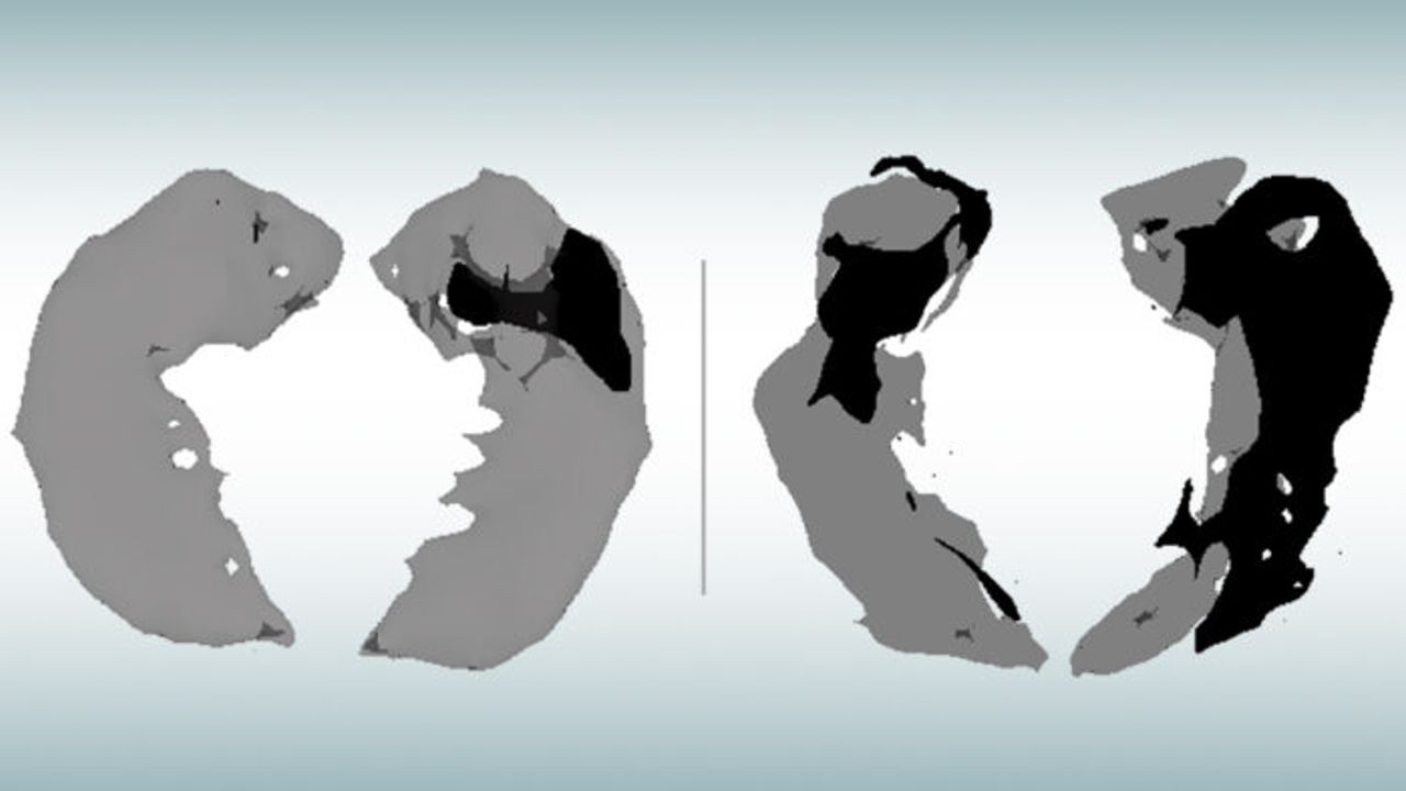 Novel MRI Approach Identifies Early-Stage Alzheimer's Damage