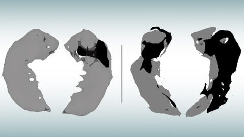 Novel MRI Approach Identifies Early-Stage Alzheimer's Damage