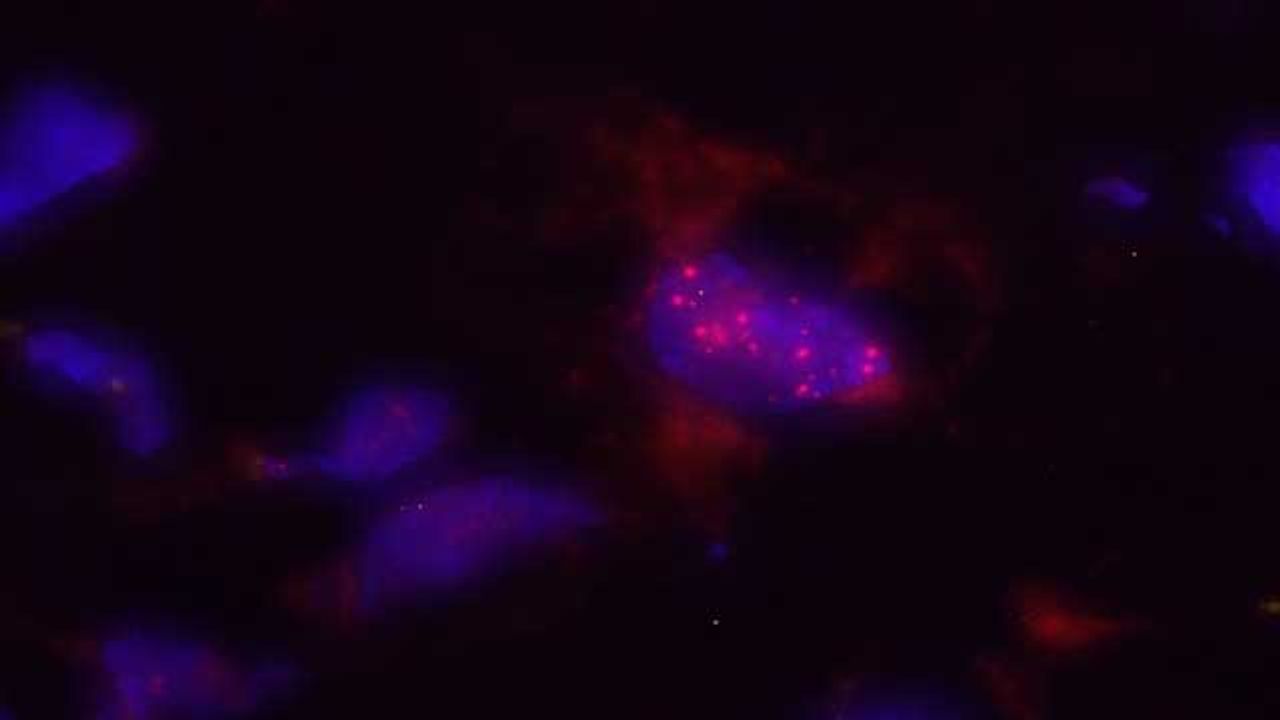 Stool Analysis Could Enable Early Detection of Pancreatic Cancer