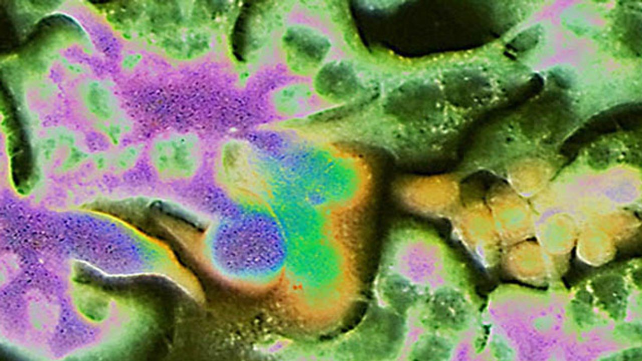 Origins of Metastasis Discovered
