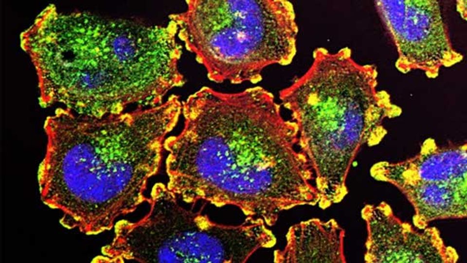 Alzheimer’s Protein Also Helps Skin Cancer Cells Thrive in the Brain content piece image