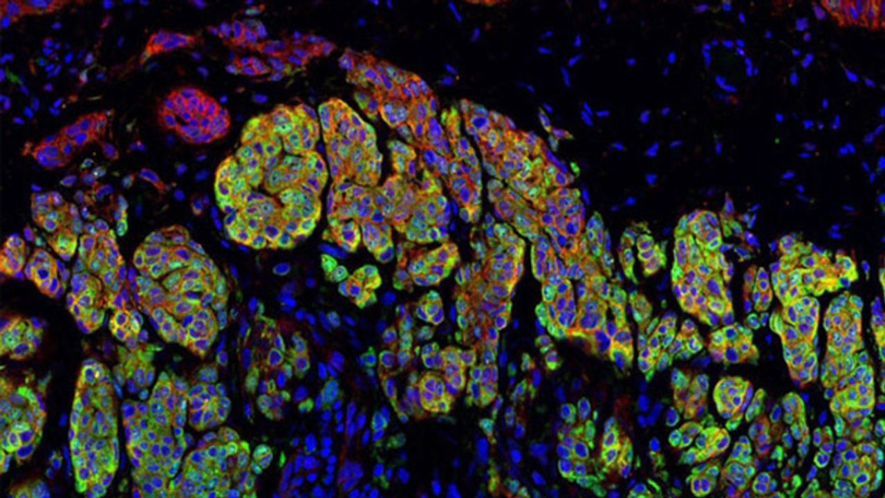 Exploiting Viral Mimicry To Treat Breast Cancer