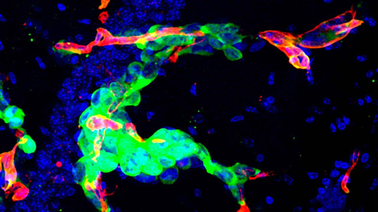 Metastasis in a Mouse Brain