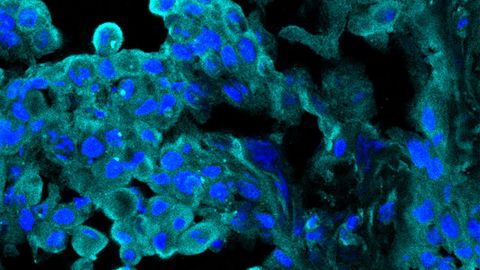 Enhancing the Antitumor Immune Response By Blocking Enzyme ART1