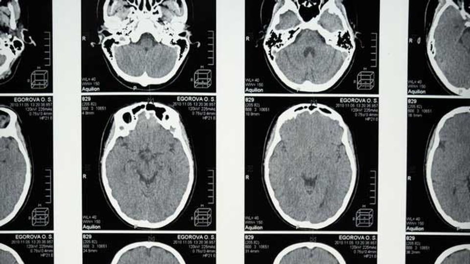 Younger Brain Tumor Patients Have Worse Outcomes Compared to Older Patients content piece image