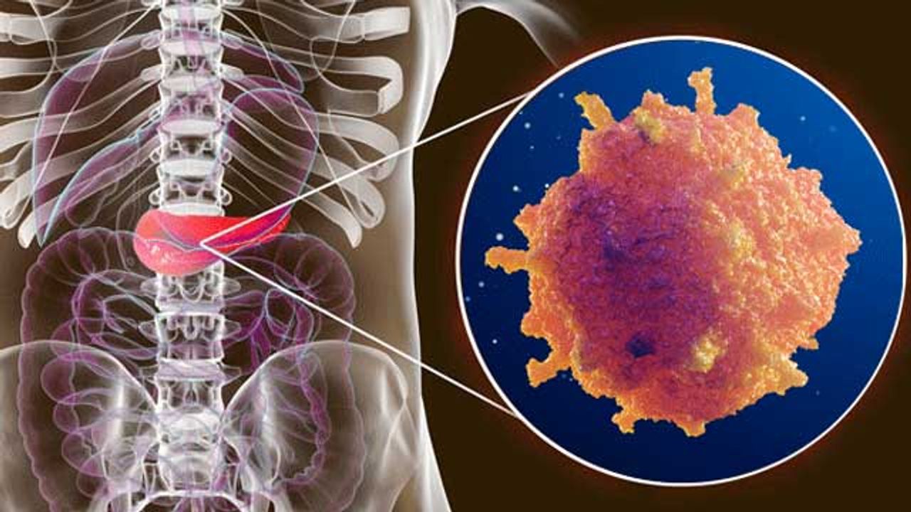 Screening Platform IDs 95% of Stage 1 Pancreatic Cancers