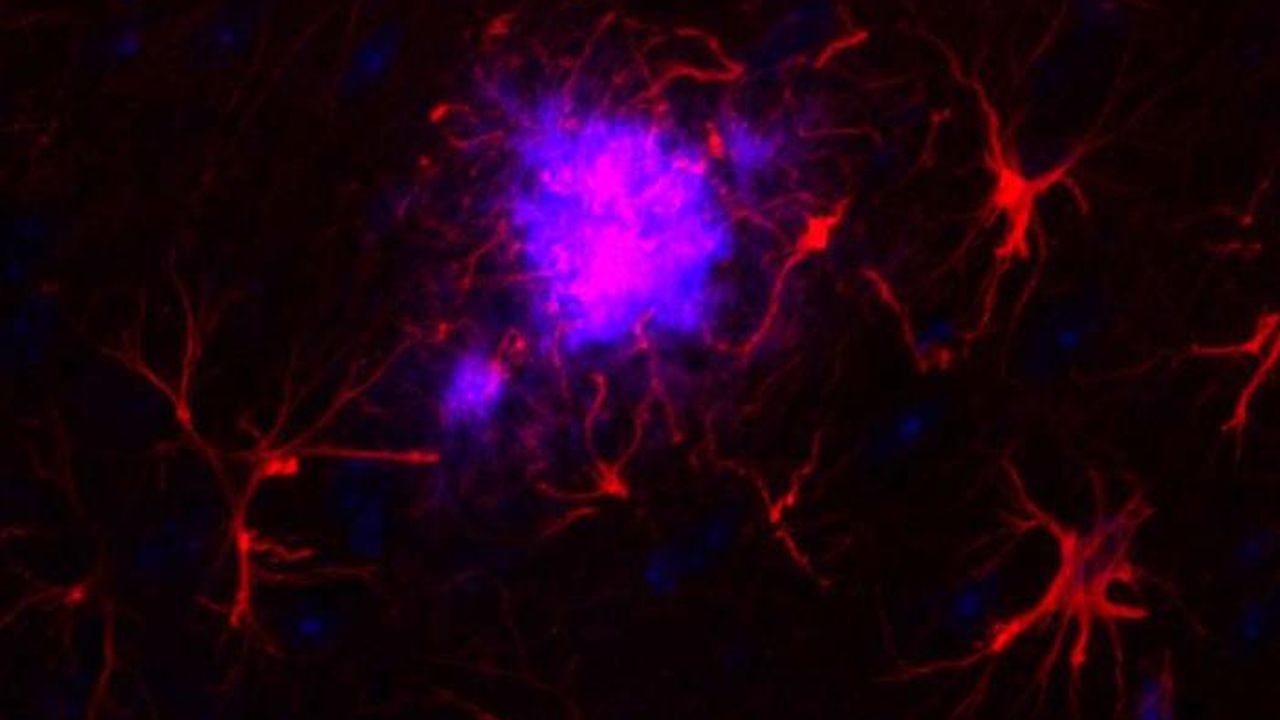 How Does Gene Expression Change in Alzheimer's Disease?