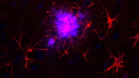 How Does Gene Expression Change in Alzheimer's Disease?