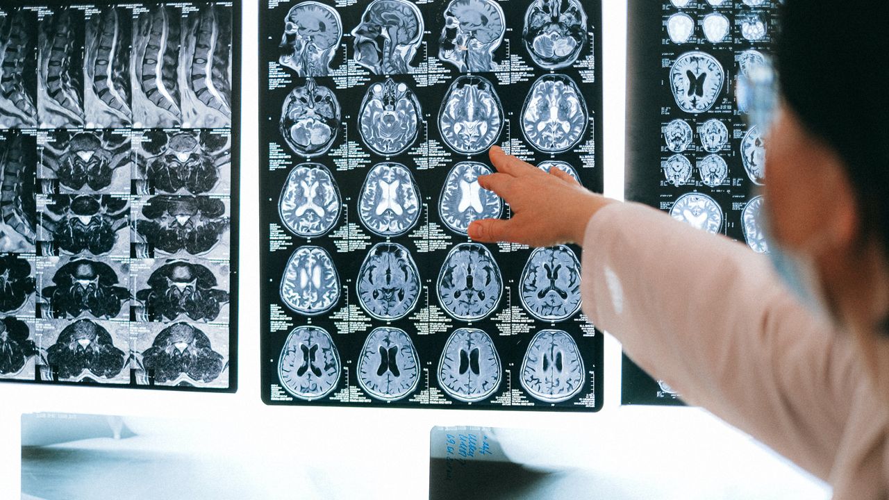 Spinal Fluid Sampling Used To Track Treatment Response in Pediatric Glioma