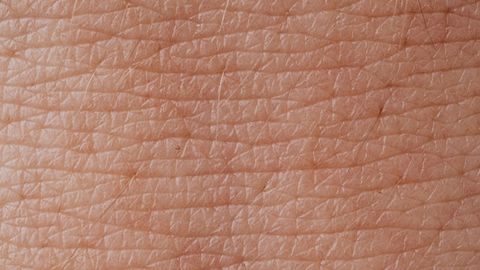 Skin Biopsies Could Be Used as ALS Diagnostics