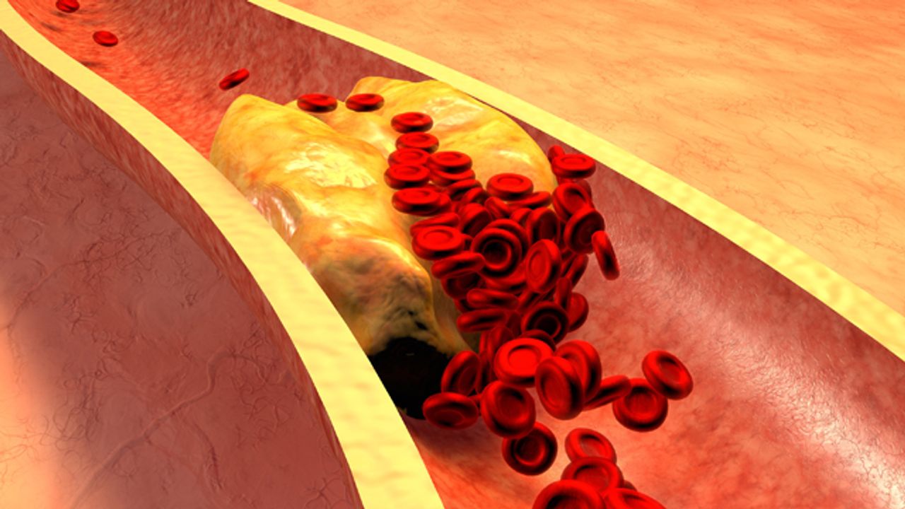 Protein Deletion Prevents Macrophage “Bad Behavior”, Reducing Atherosclerosis