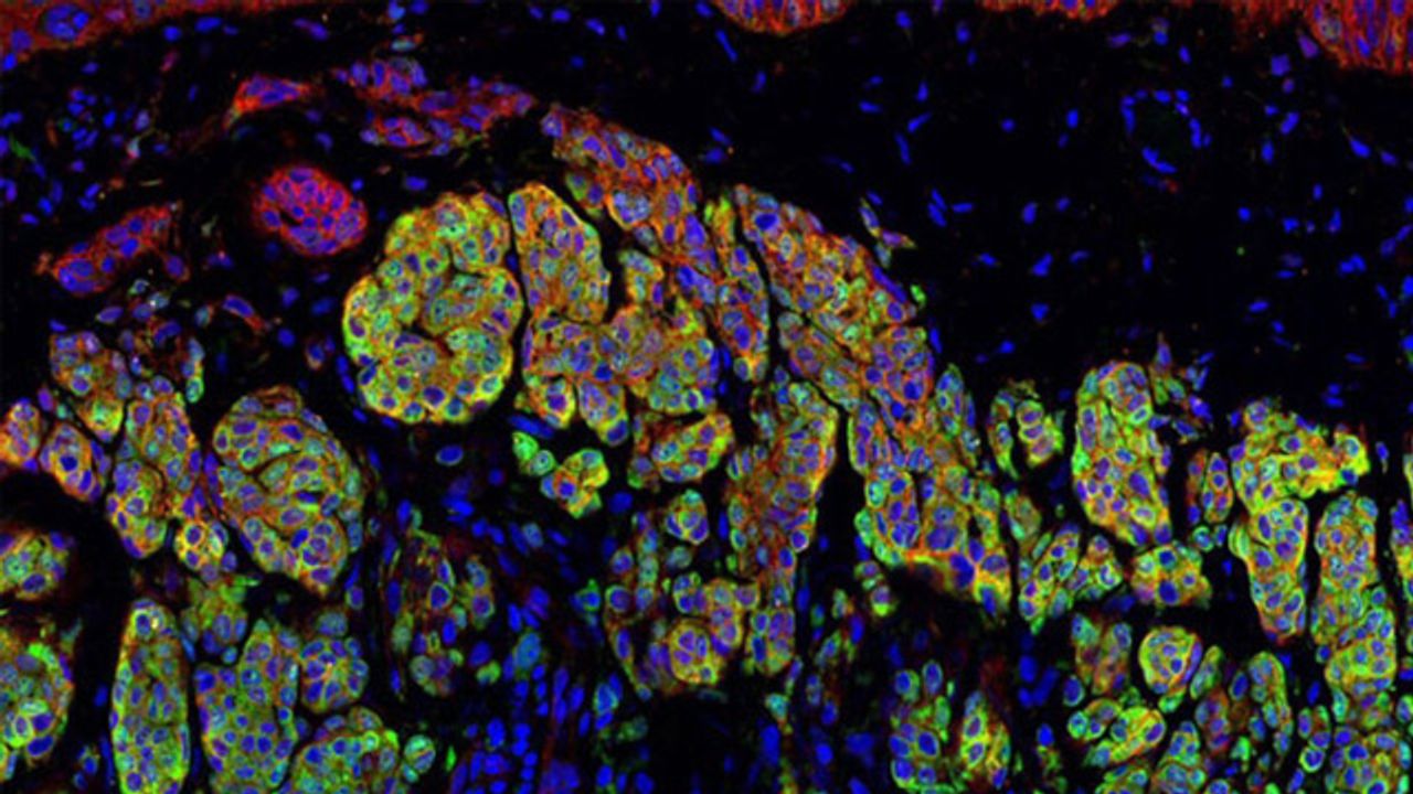 Metastatic Tumor Cells