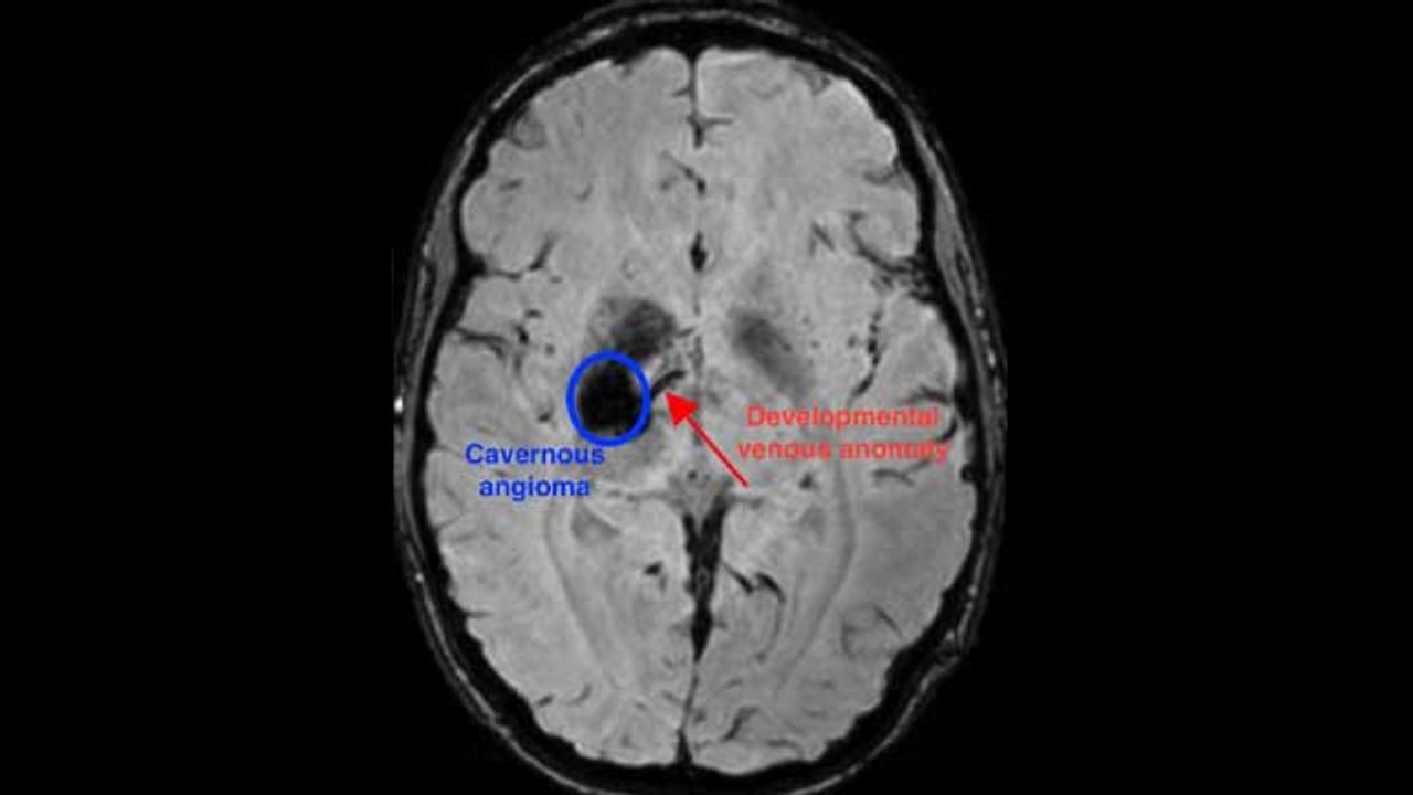 “Perfect Storm” of Genetic Mutations Underlie Rare Brain Malformations