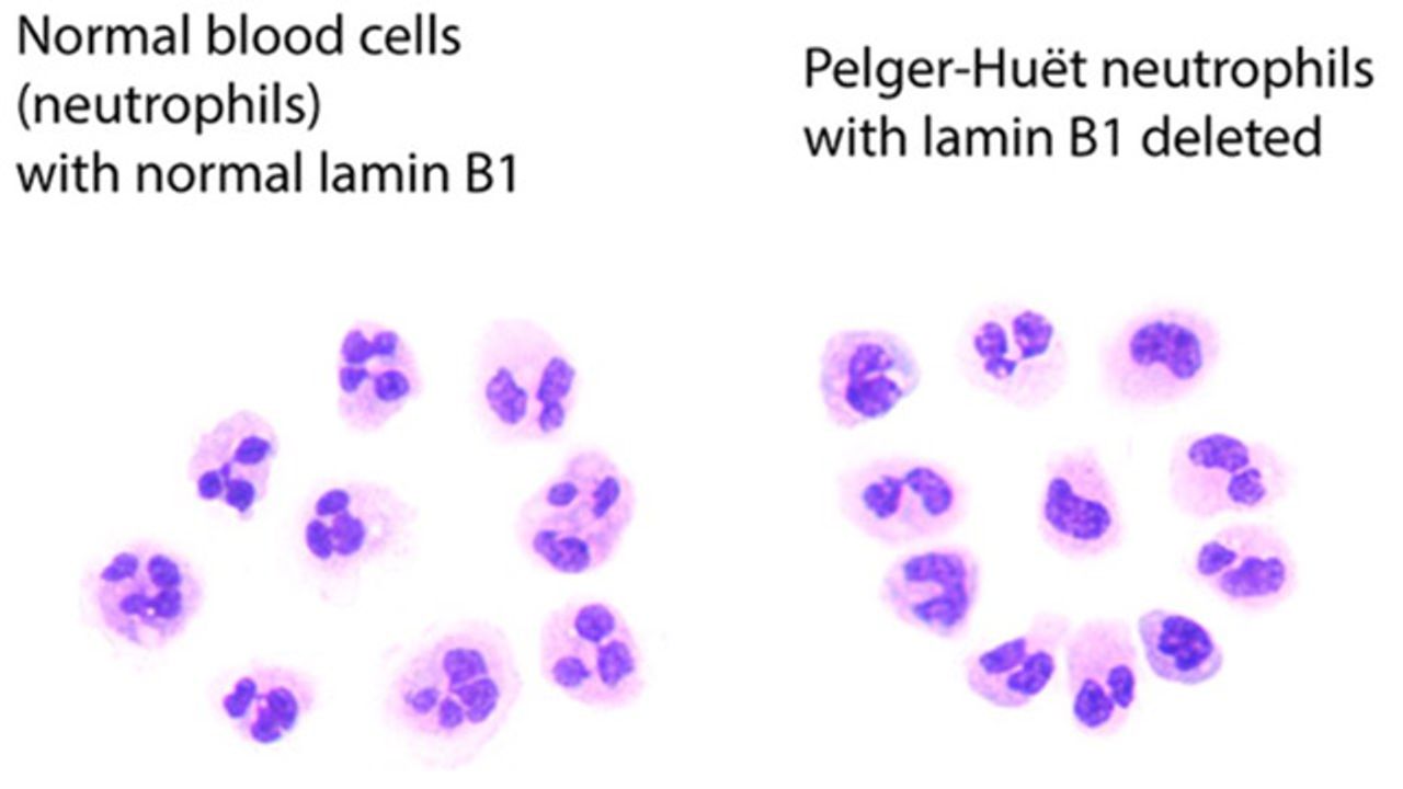 Why Some Blood Cancer Cells Have Odd-Shaped Nuclei
