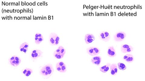 Why Some Blood Cancer Cells Have Odd-Shaped Nuclei