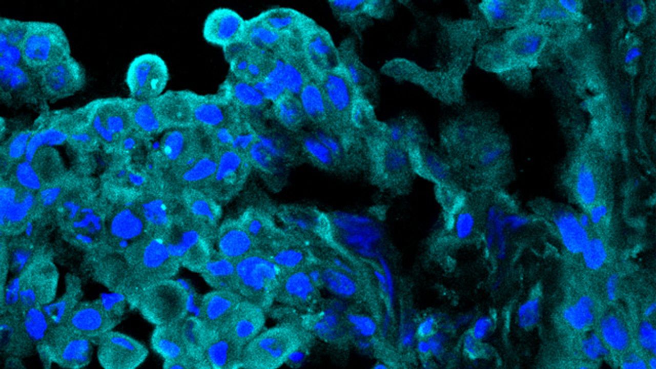 ART1 Expression in Tumor Tissue