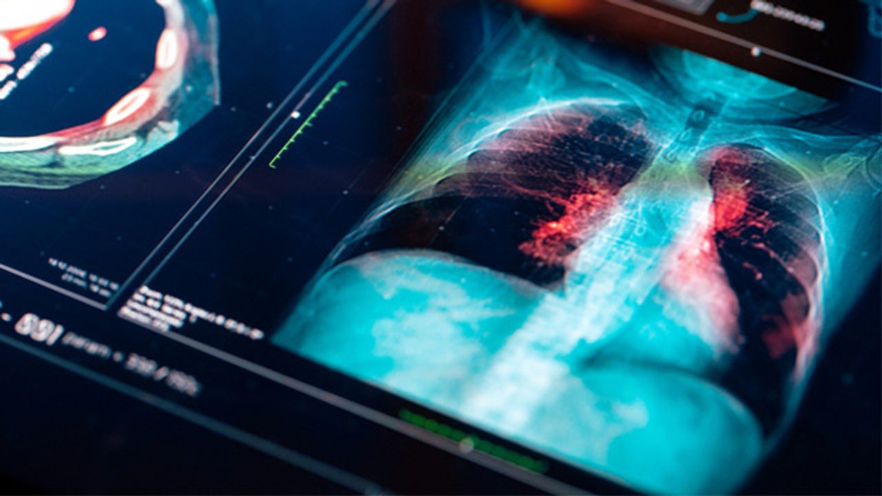 New Model To Detect and Combat Lung Cancer Recurrence Developed