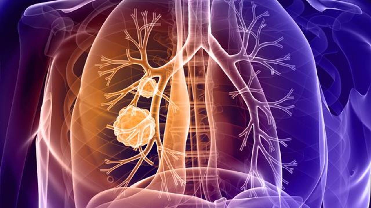 肺癌患者患有<i> ctla-4 </i>基因的变异可能对免疫疗法的反应更好