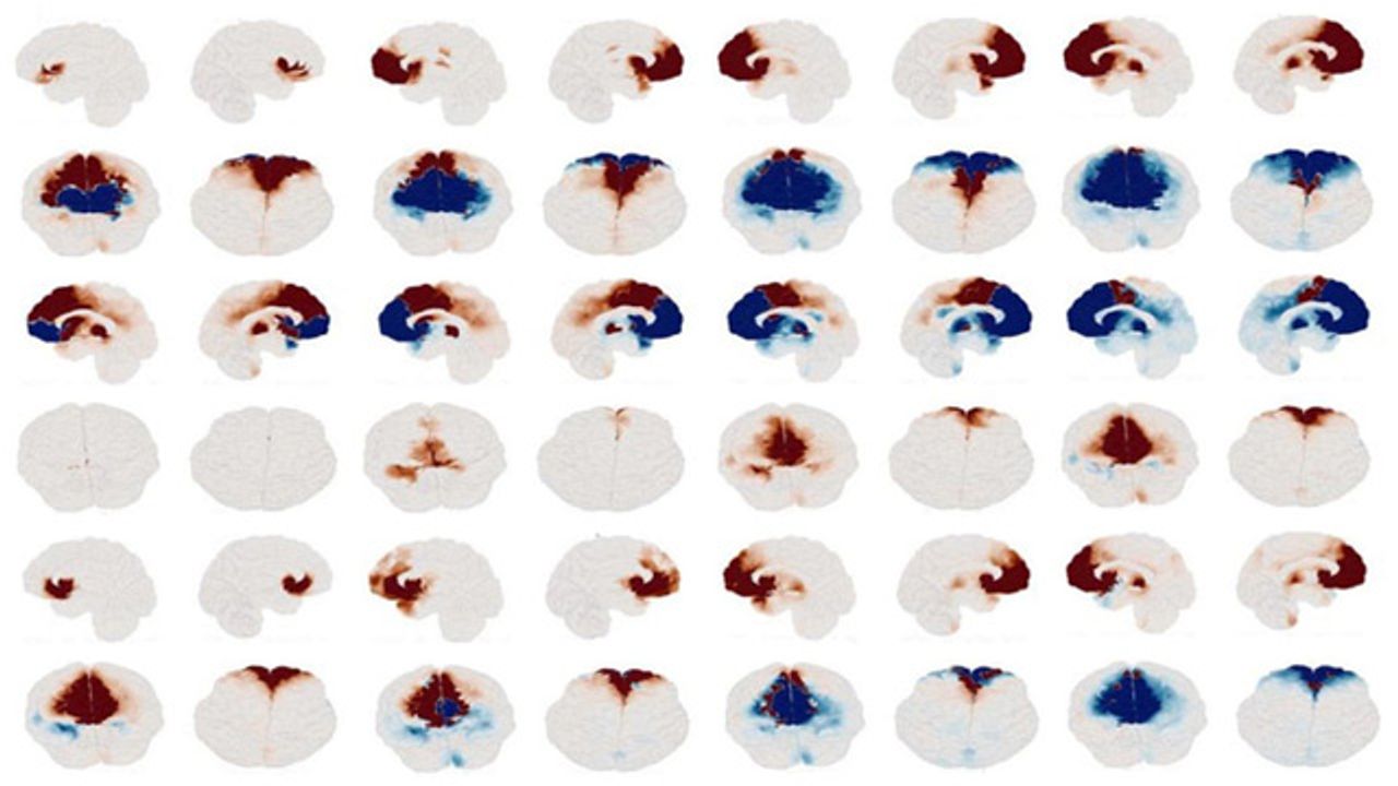 Personalized Brain Models Aim To Improve Depression Treatment