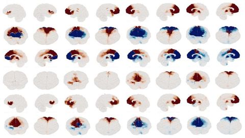 Personalized Brain Models Aim To Improve Depression Treatment