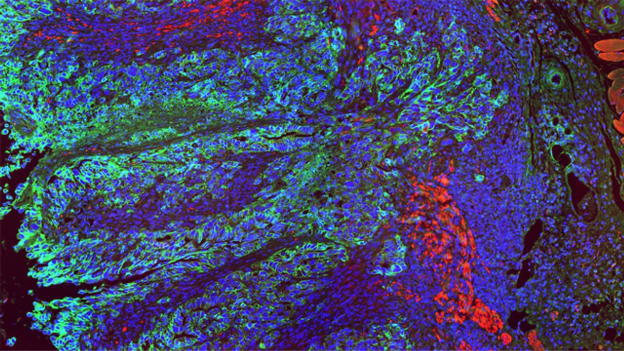 Colon Cancer Cells