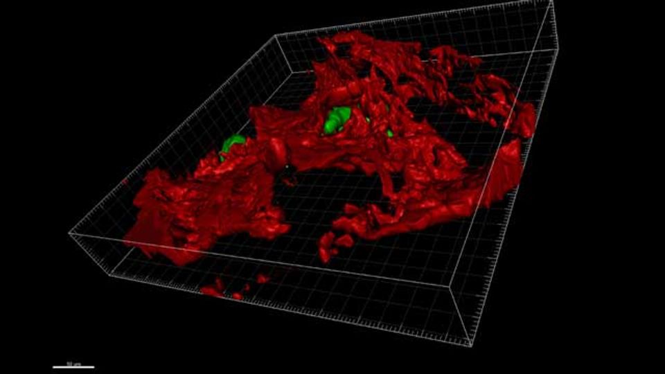 Why Some Breast Cancer Cells Spread to Bone Tissue content piece image