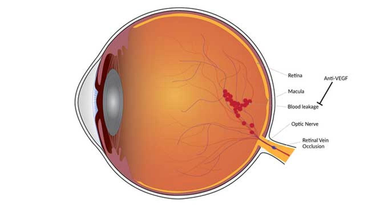Long-Lasting Vision Improvement Achieved With Treatment for Blood Vessel Condition