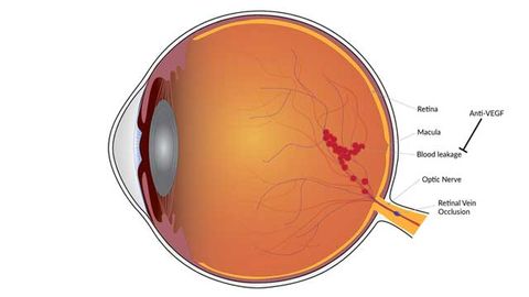 Long-Lasting Vision Improvement Achieved With Treatment for Blood Vessel Condition