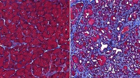 This Protein Stops the Pancreas From Digesting Itself