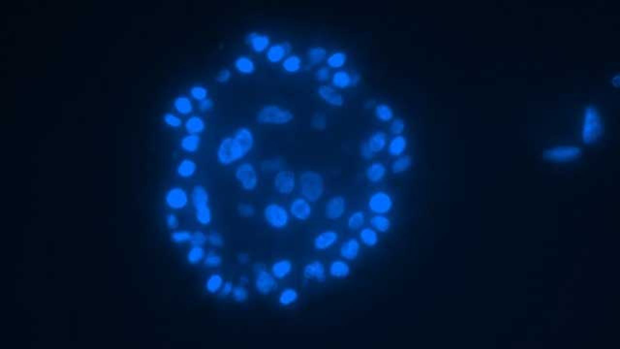 New Factors for Predicting Breast Cancer Recurrence Identified