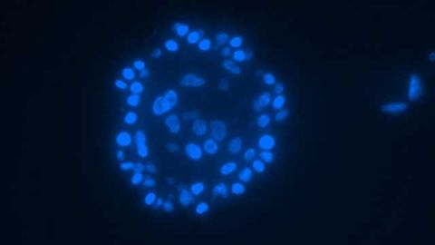 New Factors for Predicting Breast Cancer Recurrence Identified