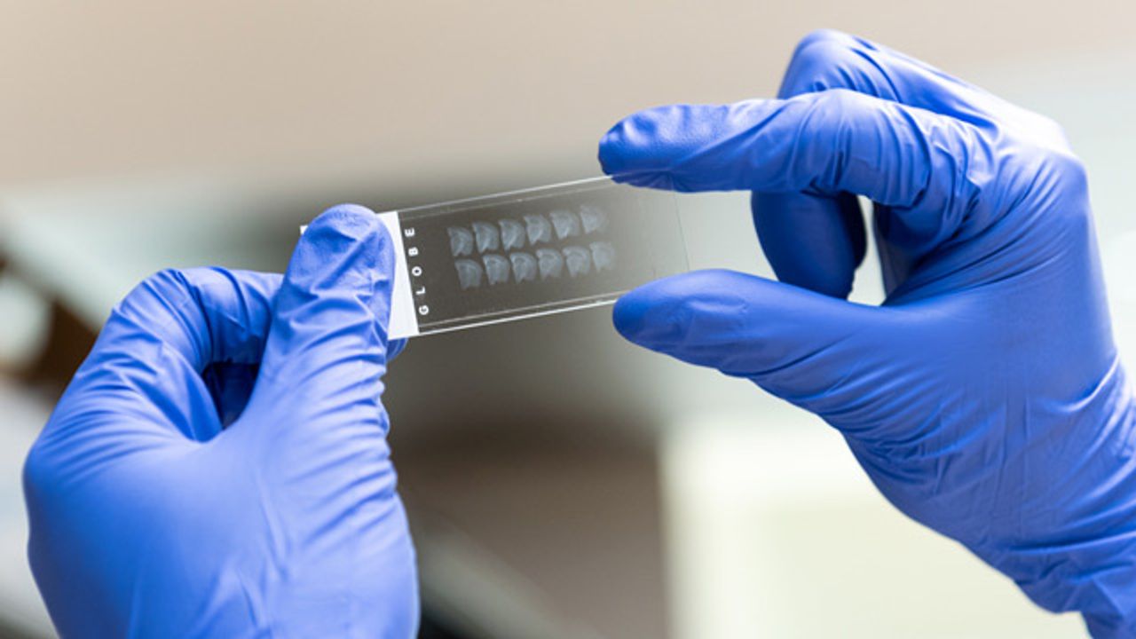 A New Way To Target Tau To Treat Autism and Epilepsy