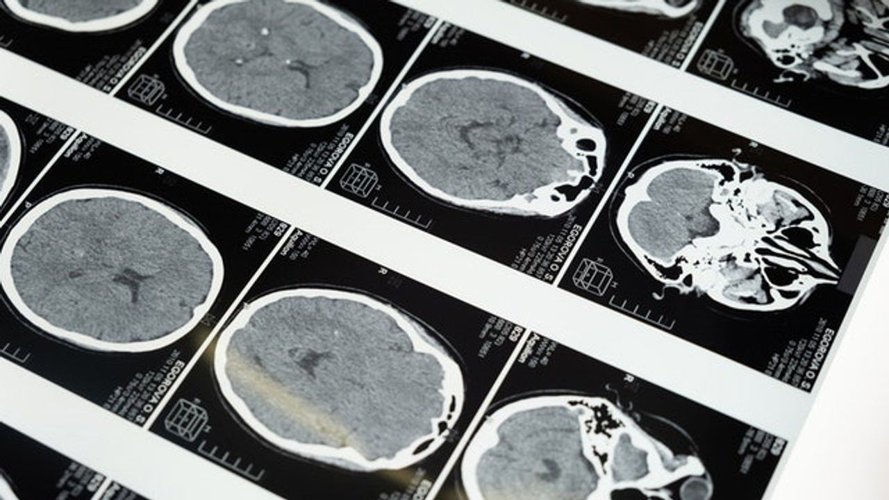 Huge Genomics Study Makes Advances in Understanding Schizophrenia