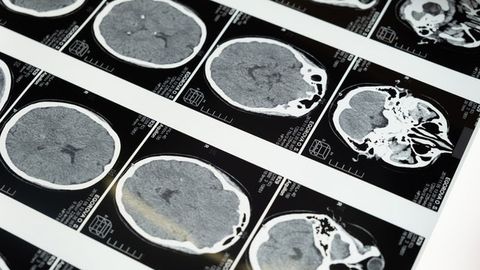 Huge Genomics Study Makes Advances in Understanding Schizophrenia