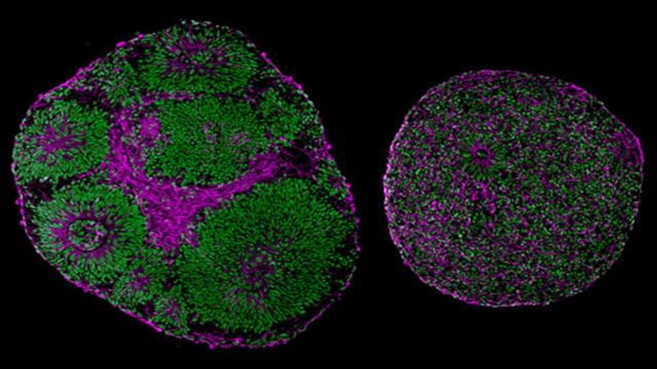 Gene Therapy Reveals Effect of Autism-Linked Mutation in Brain Organoids