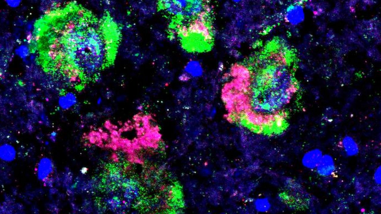 Why a Specific Type of Neuron Dies in Parkinson's Disease