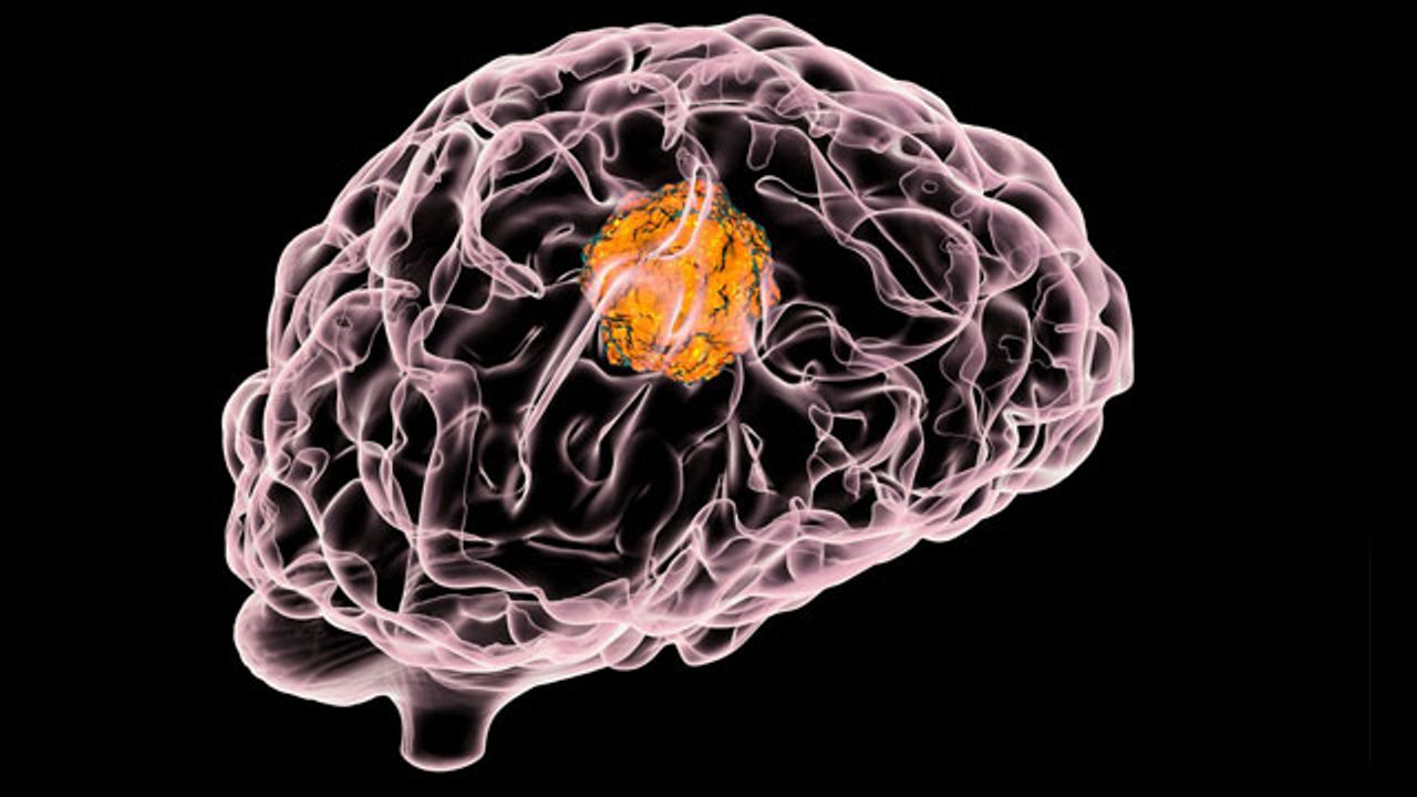 Skin Cancer Cells Depend on Alzheimer’s Protein To “Take Root” in the Brain